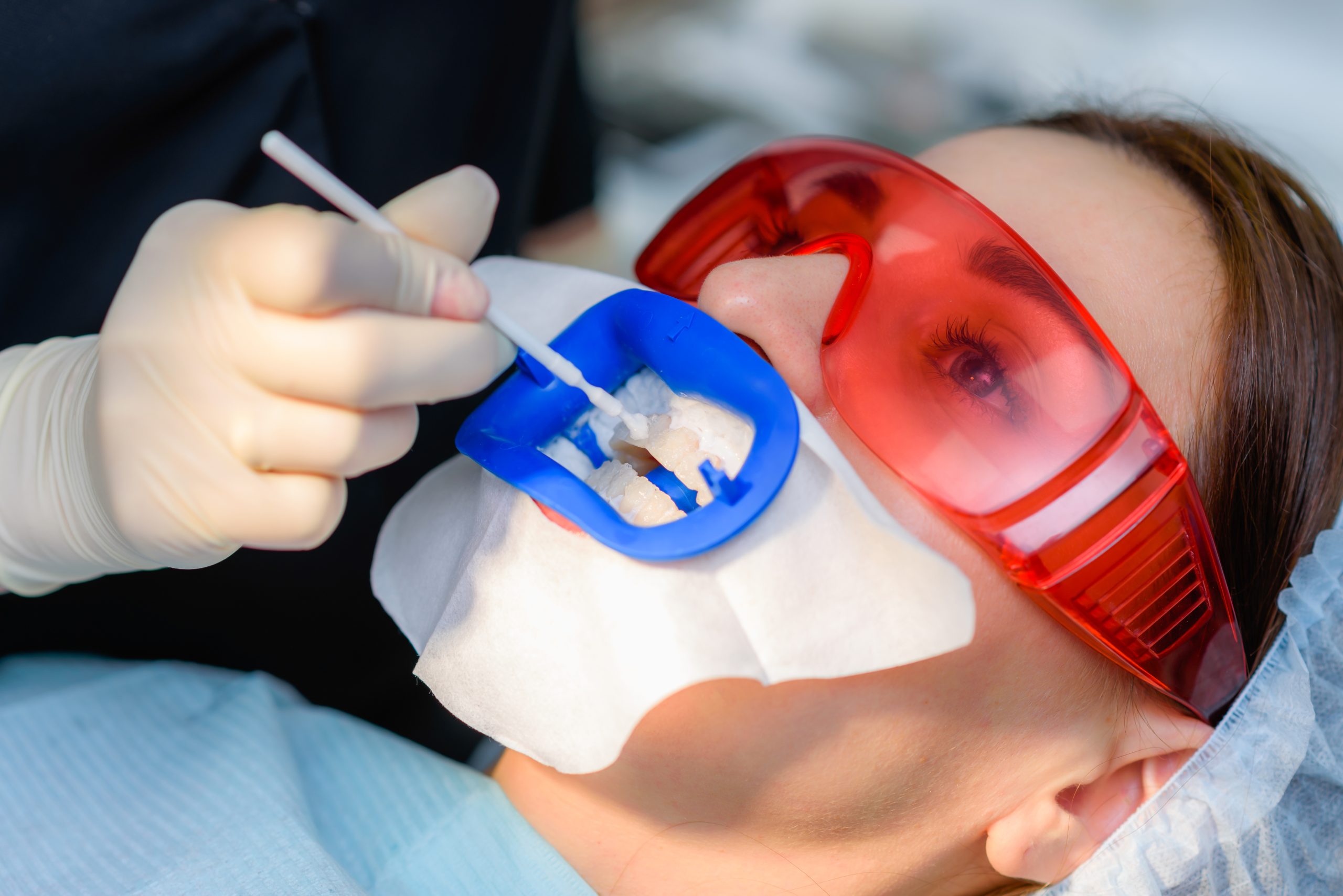 Sealing the Deal: How Dental Sealants Preserve Your Pearly Whites